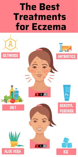 The Top 6 treatments for eczema outbreaks infographic