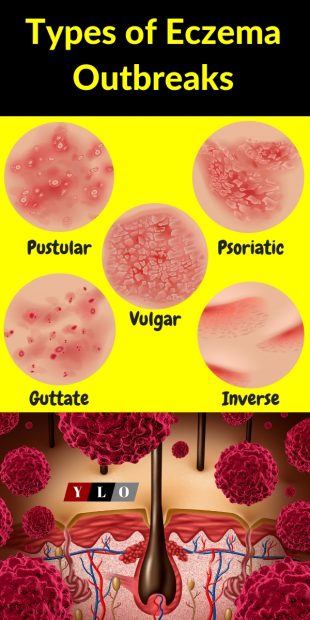 5 Types of eczema outbreaks and a skin shot of the outbreaks and how the attack the skin infographic